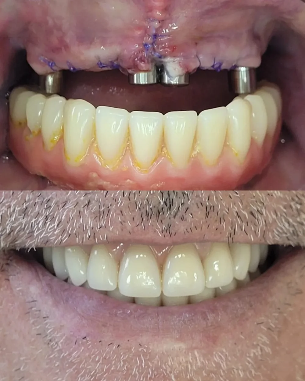Paciente reabilitado com prótese fixa sobre implantes