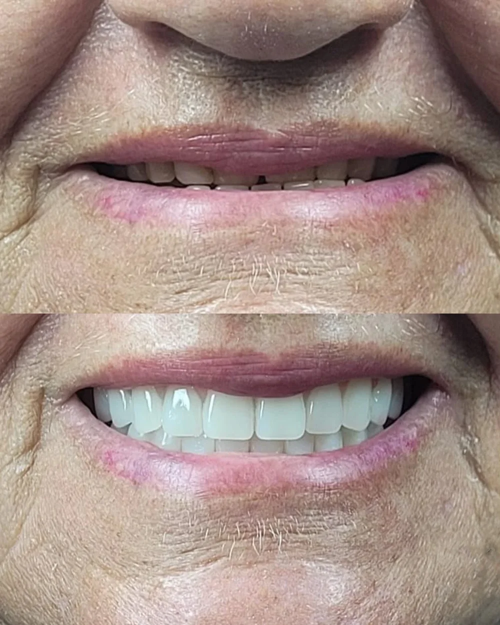 Antes e depois de paciente que recuperou os dentes fixos