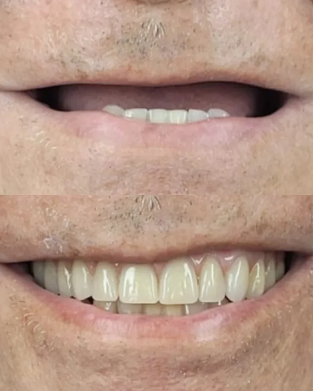Resultado de reabilitação oral com dentes fixos