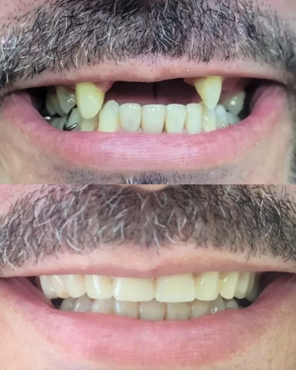 Transformação do sorriso com implantes dentários