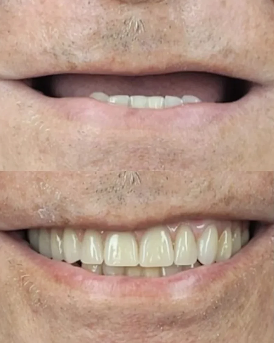 Antes e depois de paciente reabilitado com dentes fixos pela Dra. Tatiana Bisetto Casarin